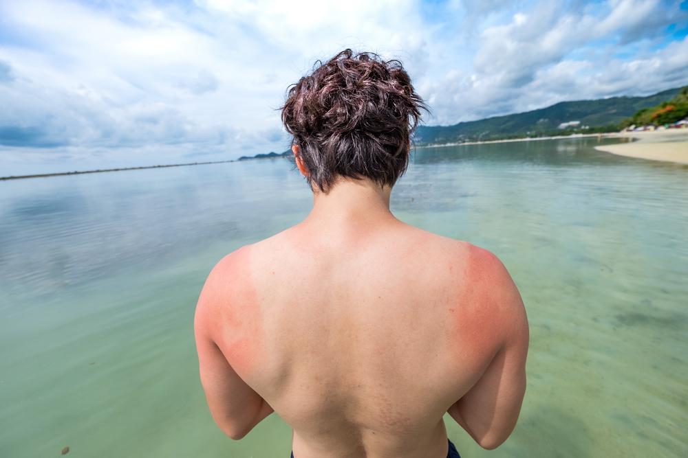 10 Natural Ways to Soothe a Sunburn