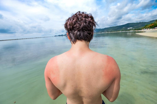 4 Natural Remedies to Treat Sunburn