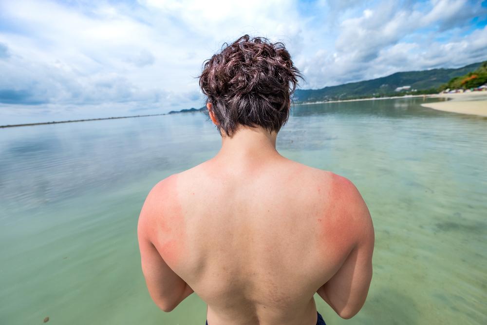 4 Natural Remedies to Treat Sunburn